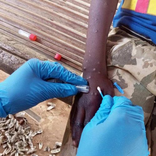 Mpox novos casos da doença no Rio Grande do S